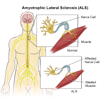 ALS and Chinese Medicine